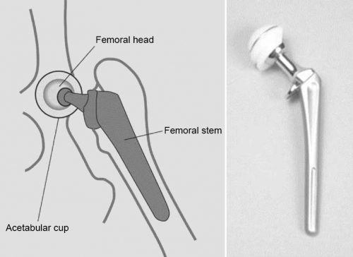 Indications And Candidate Screening For Total Hip Replacement In The