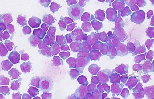 Challenges in diagnosing lymphoid neoplasia