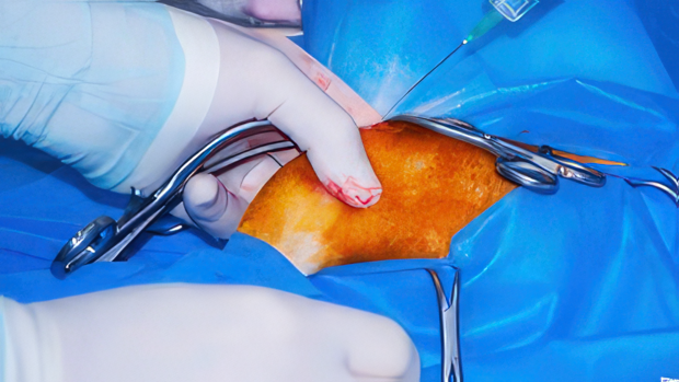 TPLO Surgery Part 3: Instrumentation, Surgical Technique, and Dry Lab